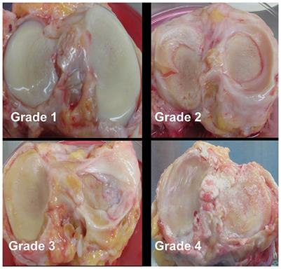 IL-15 and IL15RA in Osteoarthritis: Association With Symptoms and Protease Production, but Not Structural Severity